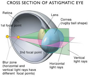 astigmatism diagram