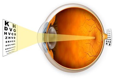 hyperopia diagram