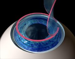 Lifting of the LASIK flap.