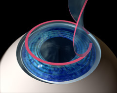 LASIK flap diagram