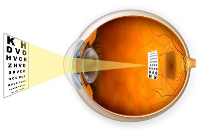 myopia diagram